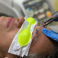 لیزر حذف تتو و پیلینگ کربن (روشن سازی بدن)