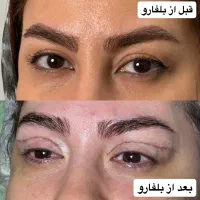 بلفارو روباهی در کلینیک مهرزاد|خدمات آرایشگری و زیبایی|تهران, جردن|دیوار