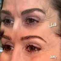 جشنواره بوتاکس کلینیک زیبایی التیام اصفهان