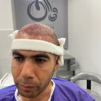 کاشت مو و ابرو نچرال