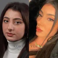 عمل بینی پروتز ساکشن لیپو ابدو بلفارو قسطی بدون چک