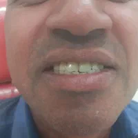 دندانسازی دندان سازی دندان مصنوعی