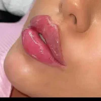 پی آر پی پوست مو و زانو پلاسمای خون PRP|خدمات آرایشگری و زیبایی|قزوین, |دیوار