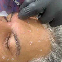 آف بلک فرایدی تزریق ژل بوتاکس فیلر ریمو تتو...|خدمات آرایشگری و زیبایی|علیآباد کتول, |دیوار