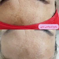فیشال صورت ،درمان مو ،تزریق ژل صورت|خدمات آرایشگری و زیبایی|کارون, |دیوار