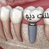 اوردنچر و ایمپلنت فقط پنج و پونصد|خدمات آرایشگری و زیبایی|رشت, کاکتوس|دیوار
