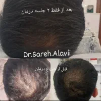 درمان ریزش مو توسط پزشک
