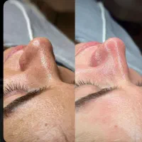 پاکسازی وفشیال ،درمان جوش ولک ۵۰درصدتخفیف واوان|خدمات آرایشگری و زیبایی|اسلام‌شهر, شهرک واوان|دیوار