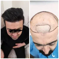 کاشت موی طبیعی با تراکم بالا در تبریز
