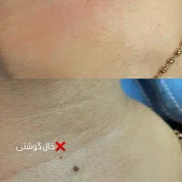 خال برداری و رفع کک ومک|خدمات آرایشگری و زیبایی|رشت, رودباری|دیوار