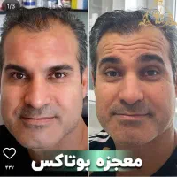 خدمات تخصصی تزریق بوتاکس فیلر بانوان و آقایون