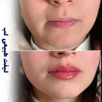 تزریق چربی،ژل،بوتاکس ونخ و مادلینگ تخصصی توسط پزشک|خدمات آرایشگری و زیبایی|کرمانشاه, |دیوار