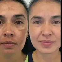 رفع دائم لک صورت