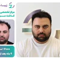 متد جدید کاشت مو در تهران با تخفیف استثنایی