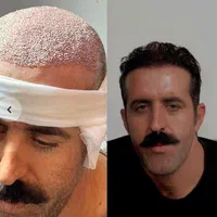 مرکزکاشت مو/ابرو/ریش دنا باتیم کاشت بین‌المللی|خدمات آرایشگری و زیبایی|یاسوج, |دیوار