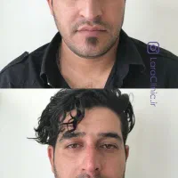 جراحی بینی فیلربینی رفع قوز بینی لیفت و کوچک کردن