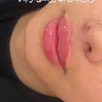 تزریق ژل لب روسی با متد تخصصی روسی و بوتاکس