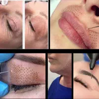 برداشتن انواع خال و فیبرو بلاست پشت پلک و بینی ..