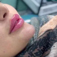 تزریق ژل و بوتاکس صورت و بدن زاویه سازی وکانتورینگ