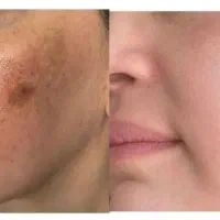 کرم ضدلک و روشن کننده بیوممتیک ایتالیا اورجینال