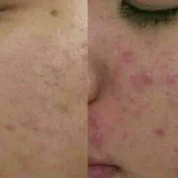 اگه قند داری چربی داری کلی مشکلات بیا|آرایشی، بهداشتی، درمانی|رشت, کوی حسینی|دیوار