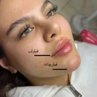 تزریق فیلر،ژل،بوتاکس|خدمات آرایشگری و زیبایی|کرمانشاه, |دیوار