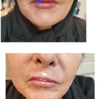 تزریق وآموزش تزریق ژل وبوتاکس ۲۵۰۰|خدمات آرایشگری و زیبایی|اهواز, طالقانی|دیوار