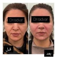 هایفو،آراف فرکشنال،کیوسوئیچ،کربوکسی،اوزون