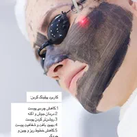 پیلینگ کربن رفع منافذباز و جوانسازی پوست توسط پزشک|خدمات آرایشگری و زیبایی|شیراز, قدوسی غربی|دیوار