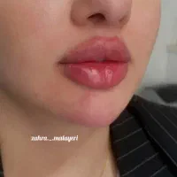 تزریق ژل فیلر تضمینی بوتاکس پرسینگ چاله گونه|خدمات آرایشگری و زیبایی|قم, نیروگاه|دیوار