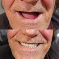 دندان مصنوعی،دندانسازی،دندان سازی،اقساطی،دندان