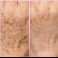 برداشتن  با لیزر لک های  پشت دست صورت خال و...