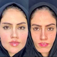 ژل و بوتاکس تضمینی