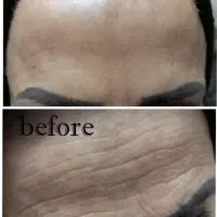 بوتاکس و فیلر