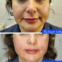 ژل بوتاکس فیلر نخ  فشیال صورت|خدمات آرایشگری و زیبایی|تبریز, |دیوار