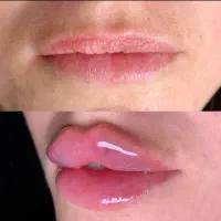 تزریق و آموزش ژل و بوتاکس مزو پی آر پی نخ و میکرو|خدمات آرایشگری و زیبایی|شیراز, ملاصدرا|دیوار