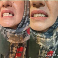 تعویض دندان مصنوعی قدیمی با دندان مصنوعی نو|آرایشی، بهداشتی، درمانی|شهرکرد, |دیوار