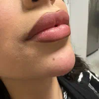 جشنواره تخفیف ژل وبوتاکس پی آرپی مزو/مادلینگ|خدمات زیبایی و سلامت|تبریز, |دیوار