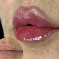 جشنواره ویژه فیلر پی ارپی مزوبوتاکس با بهترین فرم|خدمات زیبایی و سلامت|تبریز, |دیوار
