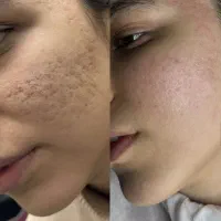 از بین بردن لک و جای جوش فرورفته صورت گچساران|خدمات آرایشگری و زیبایی|دهدشت, |دیوار