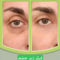 تخفیف کلینیک ژل بوتاکس نخ|خدمات آرایشگری و زیبایی|یاسوج, |دیوار