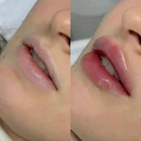 آفر ویژه تزریق ژل لب،چانه و گونه