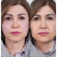 لیزر تاتو وخالکوبی ،جای جوش بخیه زخم،اندولیفت