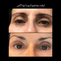 ، تزریق ژل فیلر بوتاکس مزو فیلر بادی..|خدمات آرایشگری و زیبایی|شیراز, فضل‌آباد|دیوار