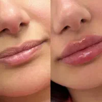 نیازمند مدل ژل لب روسی و‌کانتوریتگ صورت توسط پزشک