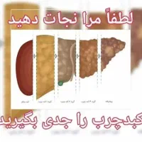 پاکسازی کبد چرب تضمینی