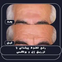 بوتاکس ویژه فقط با 690 هزارتومان