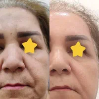 درمان چین و چروک و افتادگی