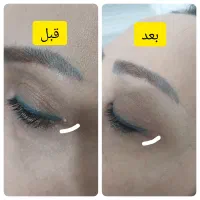 برداشتن خال و انواع ضایعه پوستی|خدمات آرایشگری و زیبایی|گرگان, |دیوار