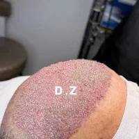 کاشت مو فول تراکم شیرازی در ساری|خدمات آرایشگری و زیبایی|ساری, |دیوار